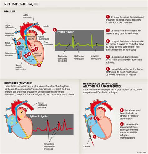 auriculares meaning|fibrillation auriculaire in english.